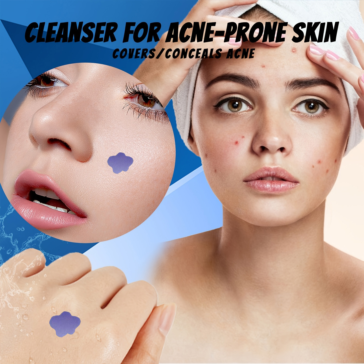 Microneedle Acne Pimple Patch  - Skincare You review and price
